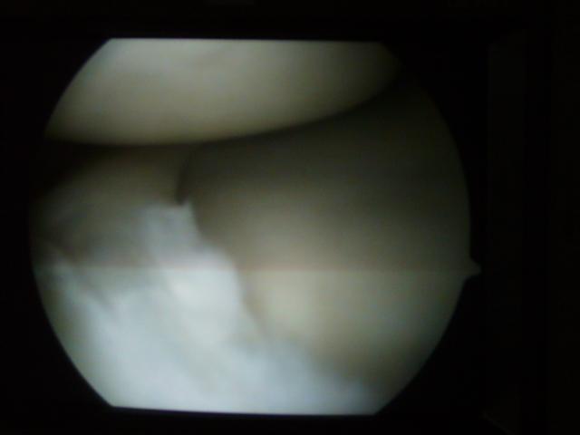 Travel - Bolivia - Knee Operation